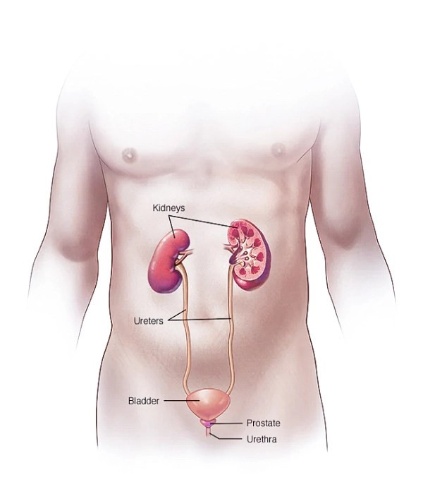 tratamiento de cáncer vesical